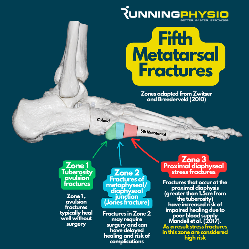 Infographic for fifth metatarsal fractures for physiotherapy purposes