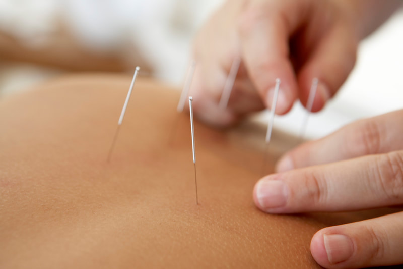 Physiotherapist placing acupuncture needles in the lumbar back